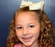 Cleft Lip and Palate Repair After Photo by Rachel Ruotolo, MD; Garden City, NY - Case 41962