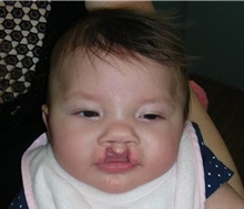 Cleft Lip and Palate Repair Before Photo by Rachel Ruotolo, MD; Garden City, NY - Case 41962