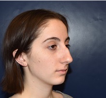 Rhinoplasty Before Photo by Rachel Ruotolo, MD; Garden City, NY - Case 41963