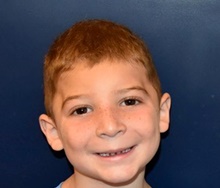 Craniosynostosis After Photo by Rachel Ruotolo, MD; Garden City, NY - Case 41968