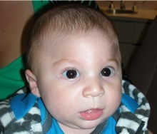 Craniosynostosis Before Photo by Rachel Ruotolo, MD; Garden City, NY - Case 41968