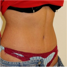 Tummy Tuck After Photo by Steve Laverson, MD, FACS; Rancho Santa Fe, CA - Case 42038