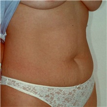 Tummy Tuck Before Photo by Steve Laverson, MD, FACS; Rancho Santa Fe, CA - Case 42038