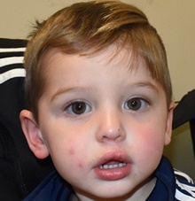 Cleft Lip and Palate Repair After Photo by Rachel Ruotolo, MD; Garden City, NY - Case 42042