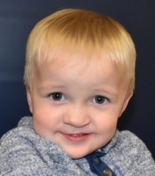 Cleft Lip and Palate Repair After Photo by Rachel Ruotolo, MD; Garden City, NY - Case 42047