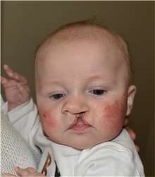 Cleft Lip and Palate Repair Before Photo by Rachel Ruotolo, MD; Garden City, NY - Case 42047