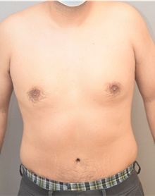 Male Breast Reduction After Photo by Keshav Magge, MD; Bethesda, MD - Case 42068