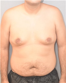 Male Breast Reduction Before Photo by Keshav Magge, MD; Bethesda, MD - Case 42068