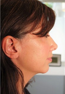 Chin Augmentation After Photo by Ellen Mahony, MD; Westport, CT - Case 42420