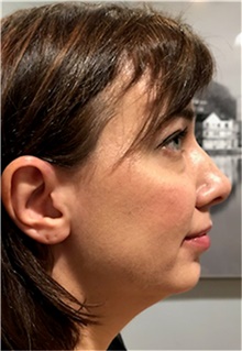 Chin Augmentation Before Photo by Ellen Mahony, MD; Westport, CT - Case 42420