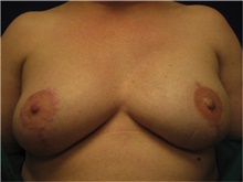 Breast Reconstruction After Photo by Nicholas Leonardi, DO; Germantown, TN - Case 42437
