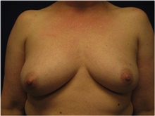 Breast Reconstruction Before Photo by Nicholas Leonardi, DO; Germantown, TN - Case 42437
