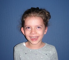 Ear Surgery Before Photo by Rachel Ruotolo, MD; Garden City, NY - Case 42481