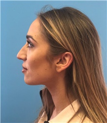 Rhinoplasty Before Photo by Mark Markarian, MD, MSPH, FACS; Wellesley, MA - Case 42531