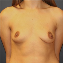 Breast Augmentation Before Photo by Steve Laverson, MD, FACS; Rancho Santa Fe, CA - Case 42673
