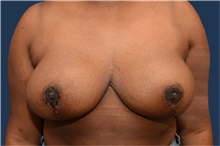 Breast Reduction After Photo by Michael Dobryansky, MD, FACS; Garden City, NY - Case 43251