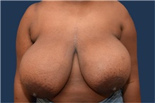 Breast Reduction Before Photo by Michael Dobryansky, MD, FACS; Garden City, NY - Case 43251
