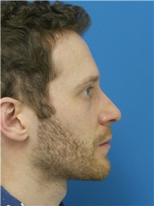 Rhinoplasty After Photo by Michael Epstein, MD, FACS; Northbrook, IL - Case 43305