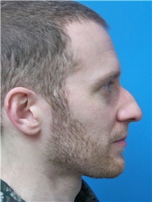 Rhinoplasty Before Photo by Michael Epstein, MD, FACS; Northbrook, IL - Case 43305