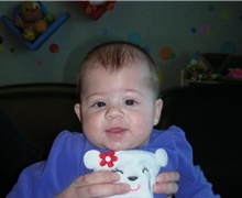 Craniosynostosis After Photo by Rachel Ruotolo, MD; Garden City, NY - Case 43375