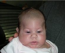 Craniosynostosis Before Photo by Rachel Ruotolo, MD; Garden City, NY - Case 43375