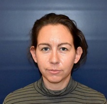 Ear Surgery Before Photo by Rachel Ruotolo, MD; Garden City, NY - Case 43388