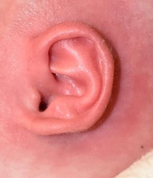 Ear Surgery After Photo by Rachel Ruotolo, MD; Garden City, NY - Case 43399