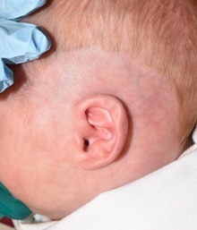 Ear Surgery Before Photo by Rachel Ruotolo, MD; Garden City, NY - Case 43399