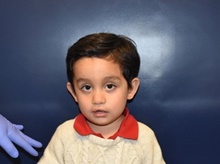 Cleft Lip and Palate Repair After Photo by Rachel Ruotolo, MD; Garden City, NY - Case 43409