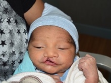 Cleft Lip and Palate Repair Before Photo by Rachel Ruotolo, MD; Garden City, NY - Case 43409