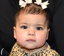 Cleft Lip and Palate Repair After Photo by Rachel Ruotolo, MD; Garden City, NY - Case 43410