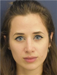 Rhinoplasty After Photo by Richard Reish, MD, FACS; New York, NY - Case 43525