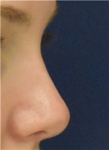 Rhinoplasty After Photo by Richard Reish, MD, FACS; New York, NY - Case 43527