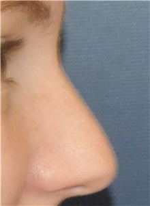 Rhinoplasty Before Photo by Richard Reish, MD, FACS; New York, NY - Case 43527