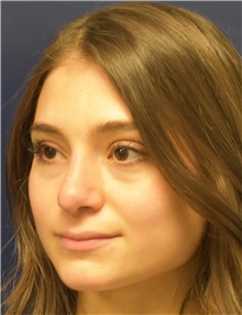 Rhinoplasty After Photo by Richard Reish, MD, FACS; New York, NY - Case 43545