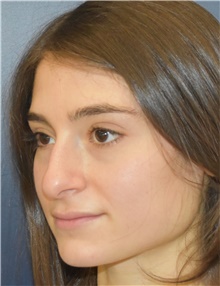 Rhinoplasty Before Photo by Richard Reish, MD, FACS; New York, NY - Case 43545