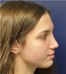 Rhinoplasty After Photo by Richard Reish, MD, FACS; New York, NY - Case 43546