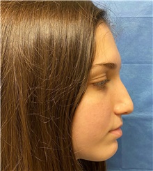 Rhinoplasty Before Photo by Richard Reish, MD, FACS; New York, NY - Case 43546