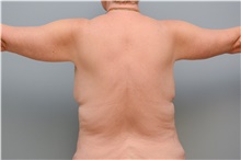 Body Contouring After Photo by Carlos Rivera-Serrano, MD; Miami Beach, FL - Case 43629