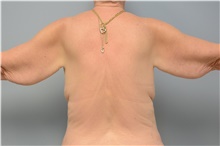 Body Contouring Before Photo by Carlos Rivera-Serrano, MD; Miami Beach, FL - Case 43629