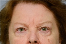 Botulinum Toxin Before Photo by Carlos Rivera-Serrano, MD; Miami Beach, FL - Case 43630