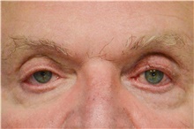 Botulinum Toxin After Photo by Carlos Rivera-Serrano, MD; Miami Beach, FL - Case 43631