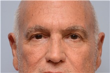 Botulinum Toxin After Photo by Carlos Rivera-Serrano, MD; Miami Beach, FL - Case 43632