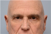 Botulinum Toxin Before Photo by Carlos Rivera-Serrano, MD; Miami Beach, FL - Case 43632