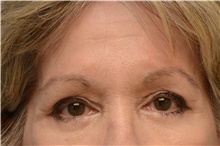 Botulinum Toxin After Photo by Carlos Rivera-Serrano, MD; Miami Beach, FL - Case 43633