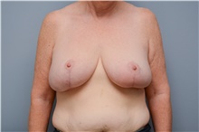Breast Reduction After Photo by Carlos Rivera-Serrano, MD; Miami Beach, FL - Case 43648