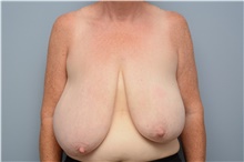 Breast Reduction Before Photo by Carlos Rivera-Serrano, MD; Miami Beach, FL - Case 43648