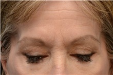Brow Lift Before Photo by Carlos Rivera-Serrano, MD; Miami Beach, FL - Case 43670