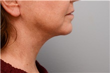 Chin Augmentation After Photo by Carlos Rivera-Serrano, MD; Miami Beach, FL - Case 43671