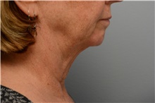 Chin Augmentation Before Photo by Carlos Rivera-Serrano, MD; Miami Beach, FL - Case 43671